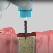 We stock a range of sub 3mm single-piece implants perfect for minimally-invasive denture stabilisation and single unit crowns.