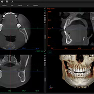 Powered by MEYER, we stock Australia's largest FOV CBCT systems, with the most affordable price tag and doctor-friendly software.